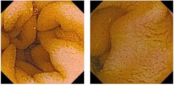 Ryc. 1. Endoskopia kapsułkowa – obraz zarejestrowany w 3 godzinie 54 minucie oraz 3 godzinie 58 minucie badania: prawidłowa struktura kosmków błony śluzowej jelita cienkiego