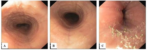 Zdjęcie 1. Obraz endoskopowy przełyku: A–B – poprzeczne bruzdowanie błony śluzowej, C – punktowy biały nalot nad wpustem