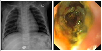 Od lewej: zdjęcie 11. metaliczne ciało obce w rzucie odźwiernika, zdjęcie 12. oparzene kanału odźwiernika