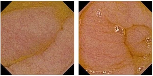 Ryc. 2 Endoskopia kapsułkowa – obraz zarejestrowany w 3 godzinie 55 minucie i 3 godzinie 56 minucie: zanikowa błona śluzowa jelita cienkiego