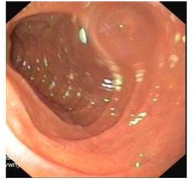 Zdjęcie 2. Obraz endoskopowy części pozaopuszkowej dwunastnicy: nieznaczne obniżenie fałdów okrężnych