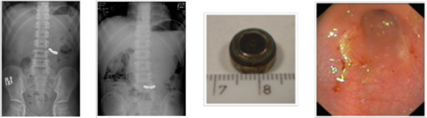 Od lewej: zdjęcie 4. baterie w żołądku, zdjęcie 5. baterie w żołądku, zdjęcie 6. usunięta bateria, zdjęcie 7. powierzchowne uszkodzenia błony śluzowej antrum