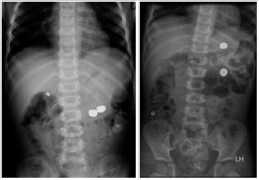 Od lewej: zdjęcie 9. zdjęcie ze szpitala kierującego – 3 ciała obce w żołądku, zdjęcie 10. zdjęcie przed zabiegiem endoskopowym – 2 ciała obce w żołądku i 1 ciało obce poza żołądkiem