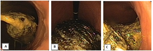 Zdjęcie 1. Obraz endoskopowy bezoara w świetle żołądka