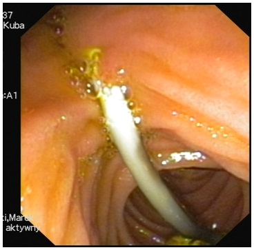 Zdjęcie 2 Obraz endoskopowy proteza żółciowa wysunięta z dróg żółciowych