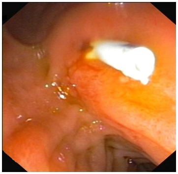 Zdjęcie 4 Obraz endoskopowy proteza żółciowa tkwiąca w brodawce Vatera