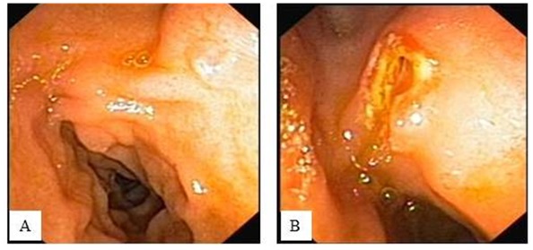zdjęcie 1 Obraz endoskopowy A – prawidłowa brodawka Vatera B – brodawka po sfincterotomii
