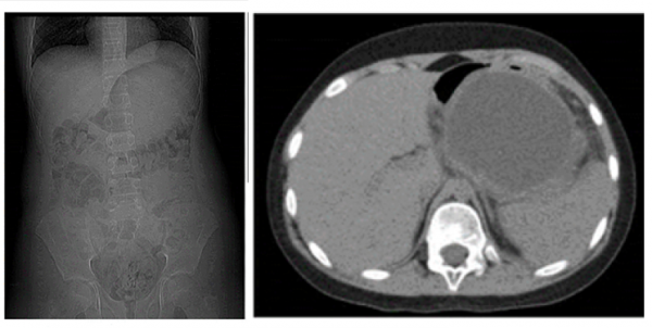 Zdjęcie 1 Tomografia komputerowa brzucha duża torbiel trzustki uciskająca żołądek i przemieszczająca jelita