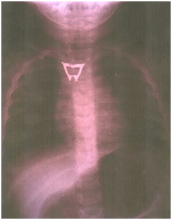 Zdjęcie 1. Badanie RTG klatki piersiowej uwidaczniające metaliczne ciało obce na wysokości Th2–Th3.