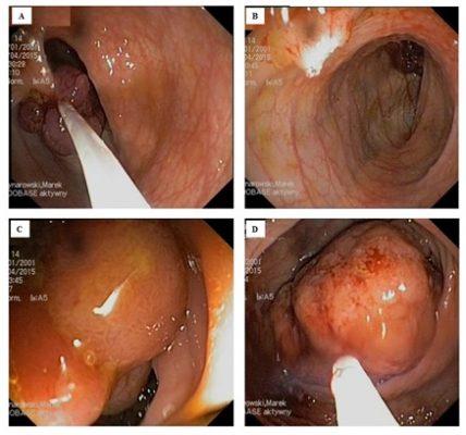 Zdjęcie 1. Badanie endoskopowe (28 kwietnia 2015 r.) – mnogie polipy jelita grubego