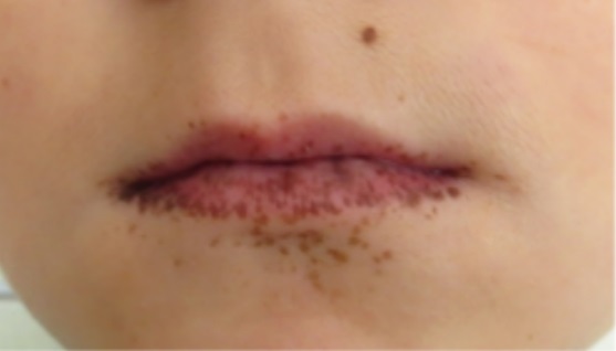 Zdjęcie 1. Hiperpigmentacja czerwieni wargowej i skóry.