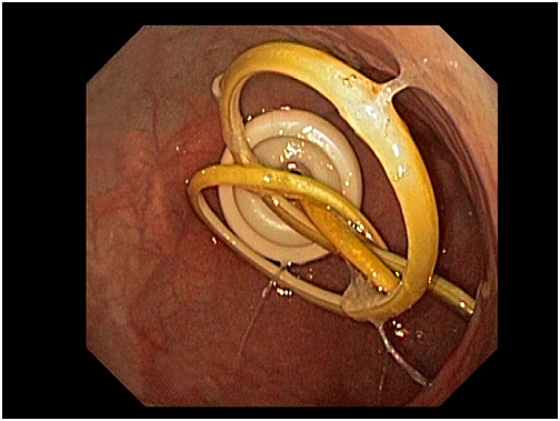 Zdjęcie 1. Kilkukrotne zapętlenie drenu jejunostomijnego wprowadzonego do żołądka przez gastrostomię.
