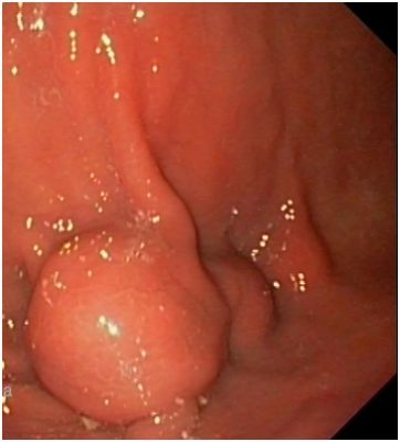 Zdjęcie 1. Obraz endoskopowy krzywizny większej żołądka