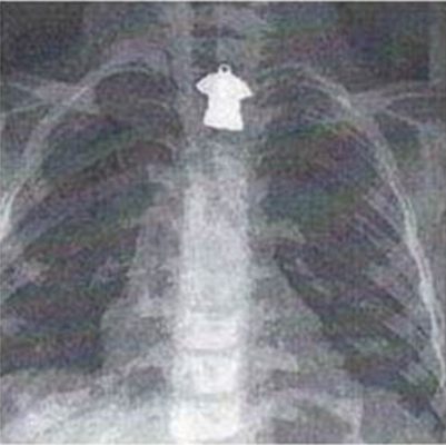 Zdjęcie 1. Obraz radiologiczny.