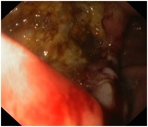 Zdjęcie 1. Pierwsze badanie endoskopowe, rozległe owrzodzenie przedniej ściany żołądka.