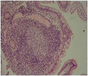 Zdjęcie 2. Obraz mikroskopowy błony śluzowej dwunastnicy, pobudzona grudka chłonna ze zwiększoną aktywnością mitotyczną jąder komórkowych.