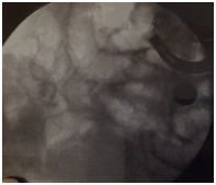 Zdjęcie 3. Badania RTG na sali endoskopowej w trakcie gastroskopii.