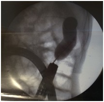 Zdjęcie 6. Badanie radiologiczne – balon ciśnieniowy rozprężony w obrębie zwężenia.